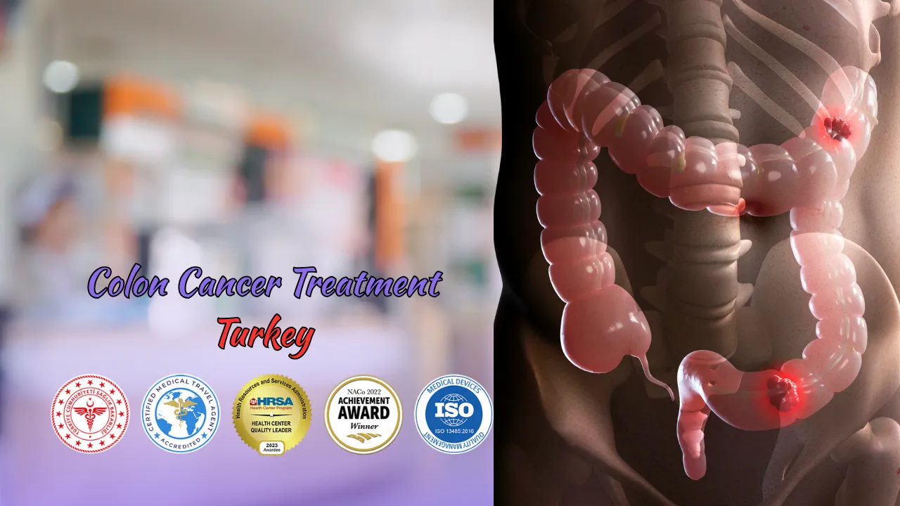 Colon Cancer Treatment Turkey