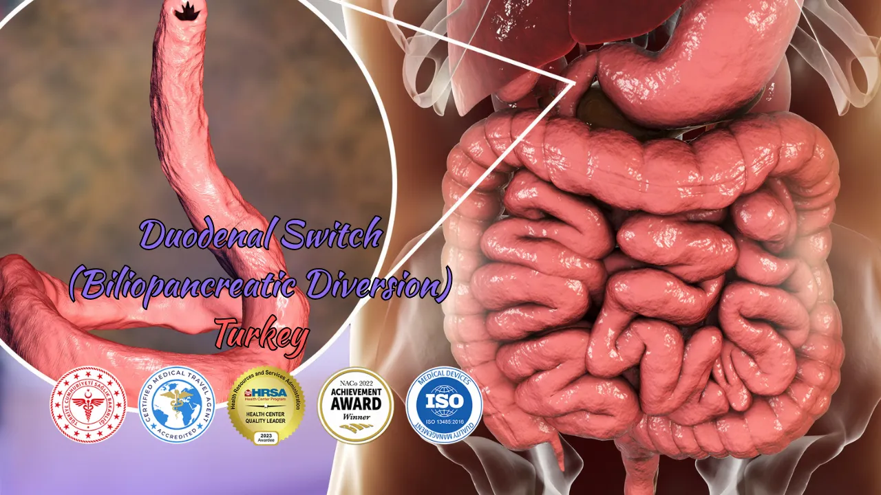 Duodenal Switch (Biliopancreatic Diversion) Turkey