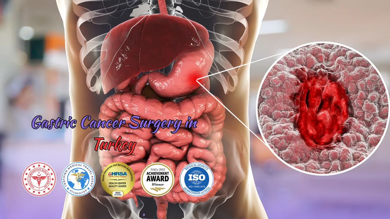 Gastric Cancer Surgery in Turkey