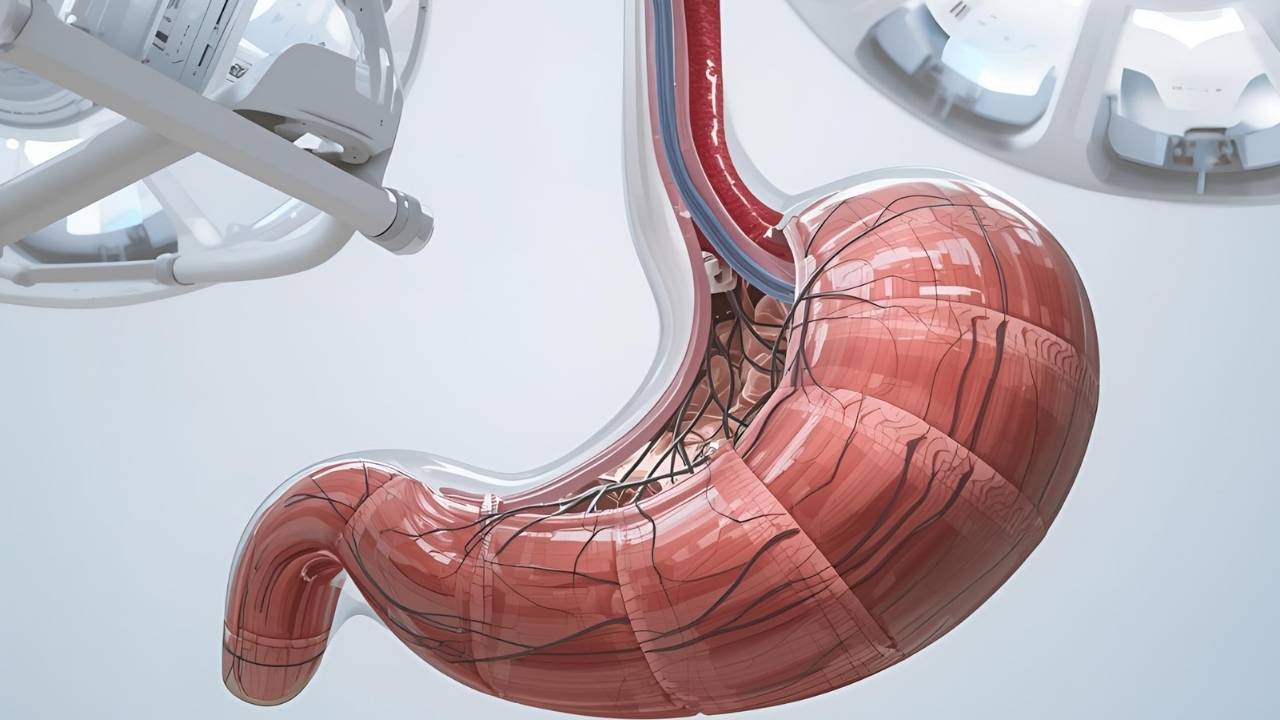 révision de la sleeve gastrique